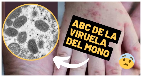 ABC de la viruela del mono